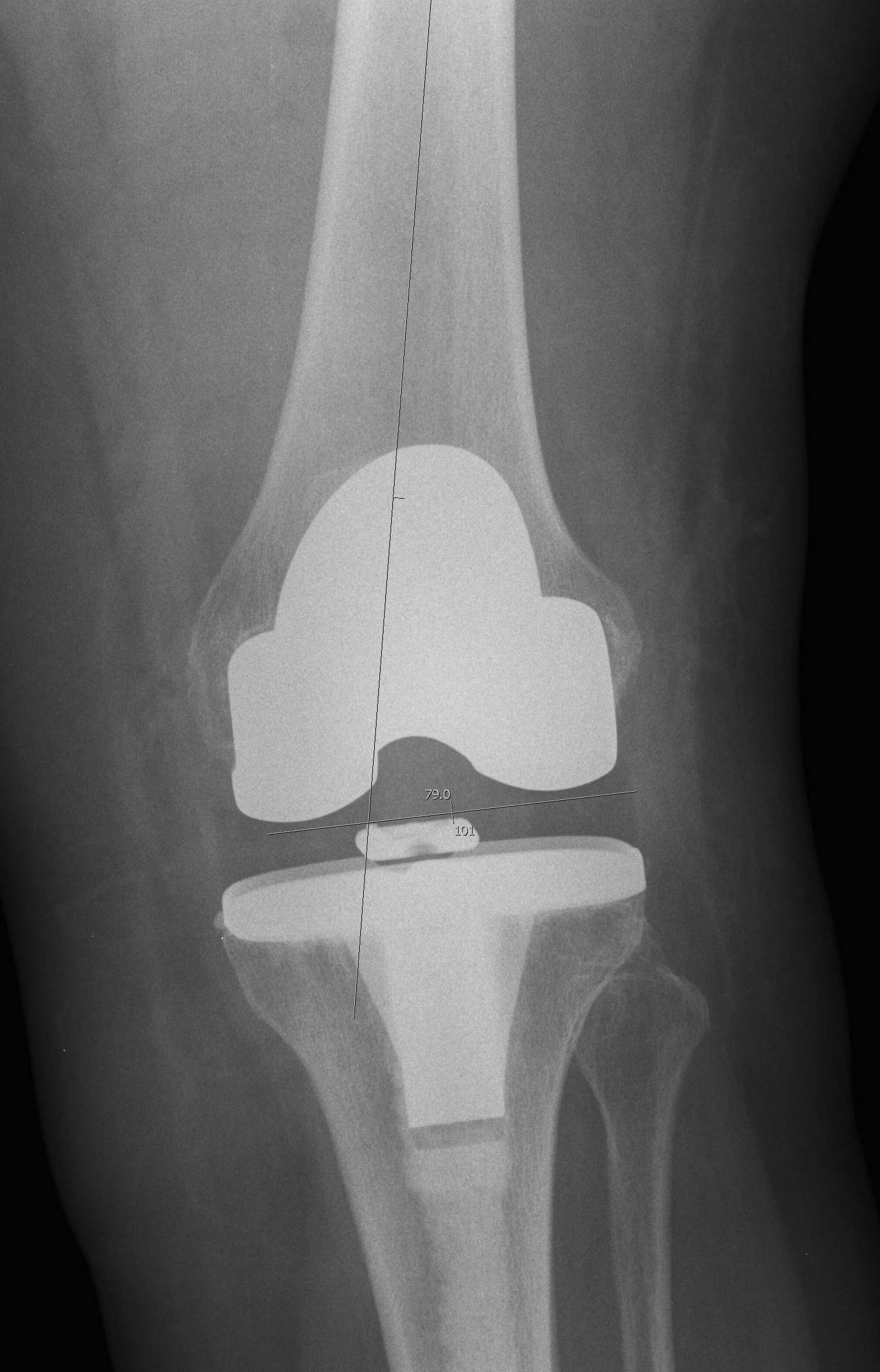 TKR Valgus Femoral Implant